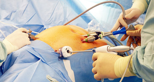 Diagnostic Laparoscopy