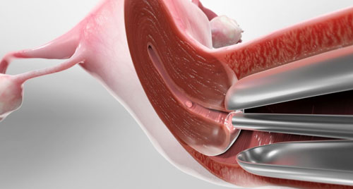 Gynaecology Hysteroscopy