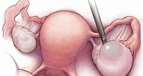Laparoscopic Cystectomy