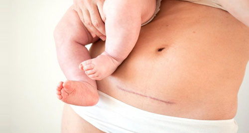 Vaginal Birth After Cesarean